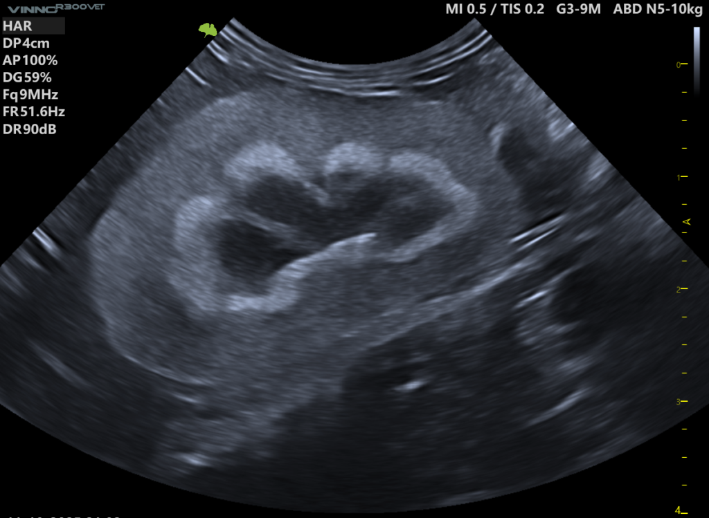 objaw pasma rdzeniowego (Medullary Band Sign)